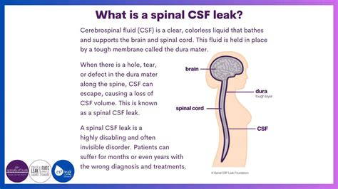 Leakweek 2023 Day One Spinal Csf Leak Foundation Leakweek 2023 Day One Spinal Csf Leak Foundation